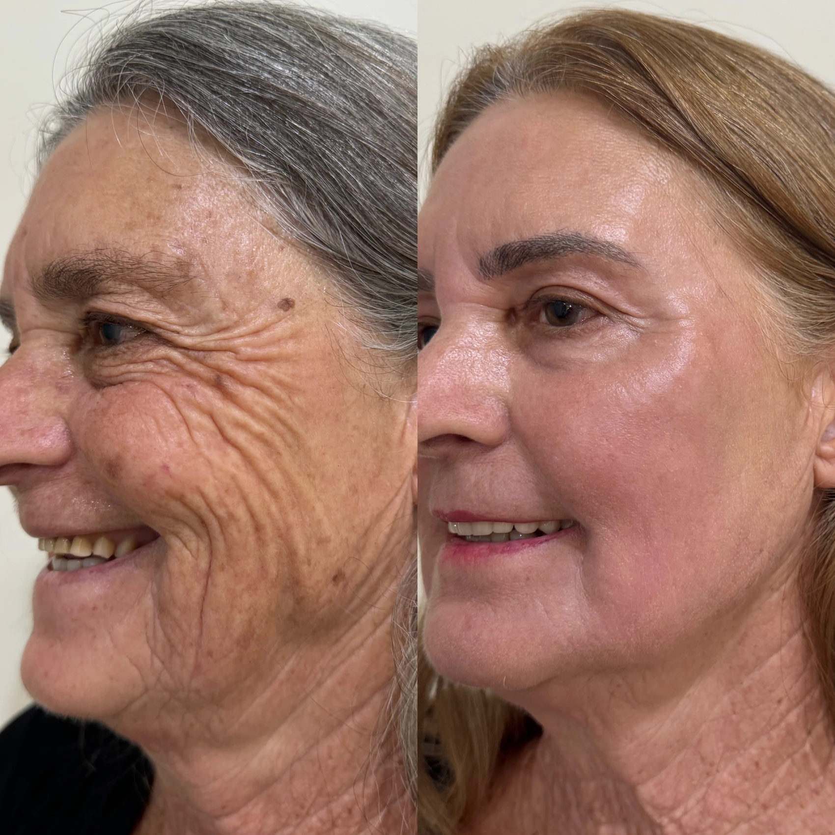 Antes e depois de paciente tratada pela Dra. Vanessa Goes — caso 1