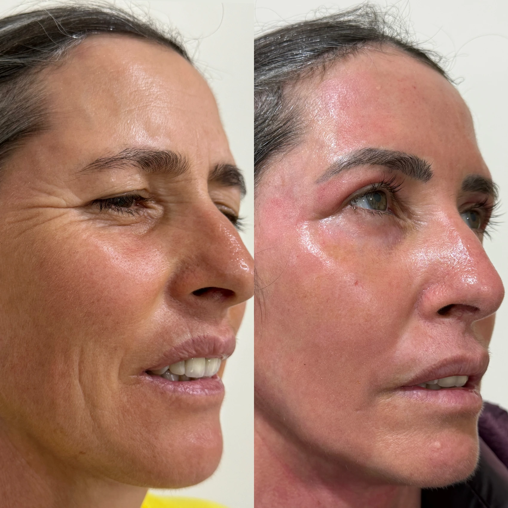 Antes e depois de paciente tratada pela Dra. Vanessa Goes — caso 2