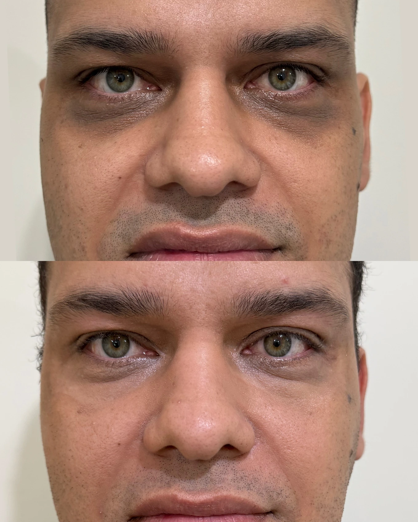 Antes e depois de paciente tratada pela Dra. Vanessa Goes — caso 3