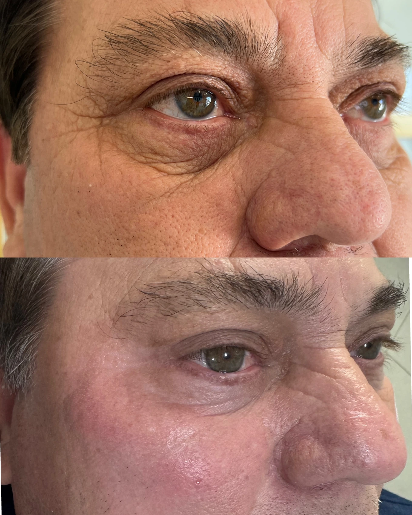 Antes e depois de paciente tratada pela Dra. Vanessa Goes — caso 4