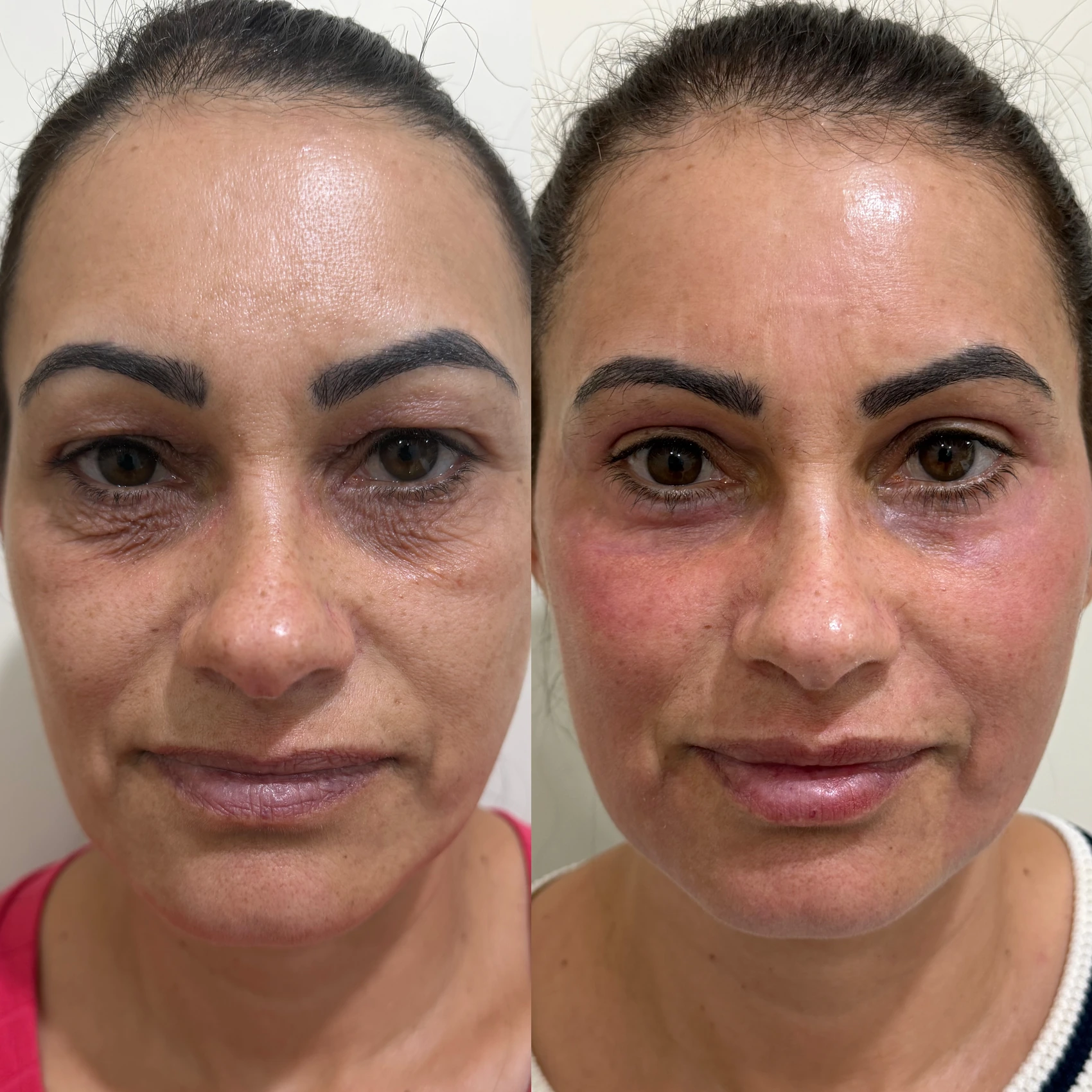 Antes e depois de paciente tratada pela Dra. Vanessa Goes — caso 5