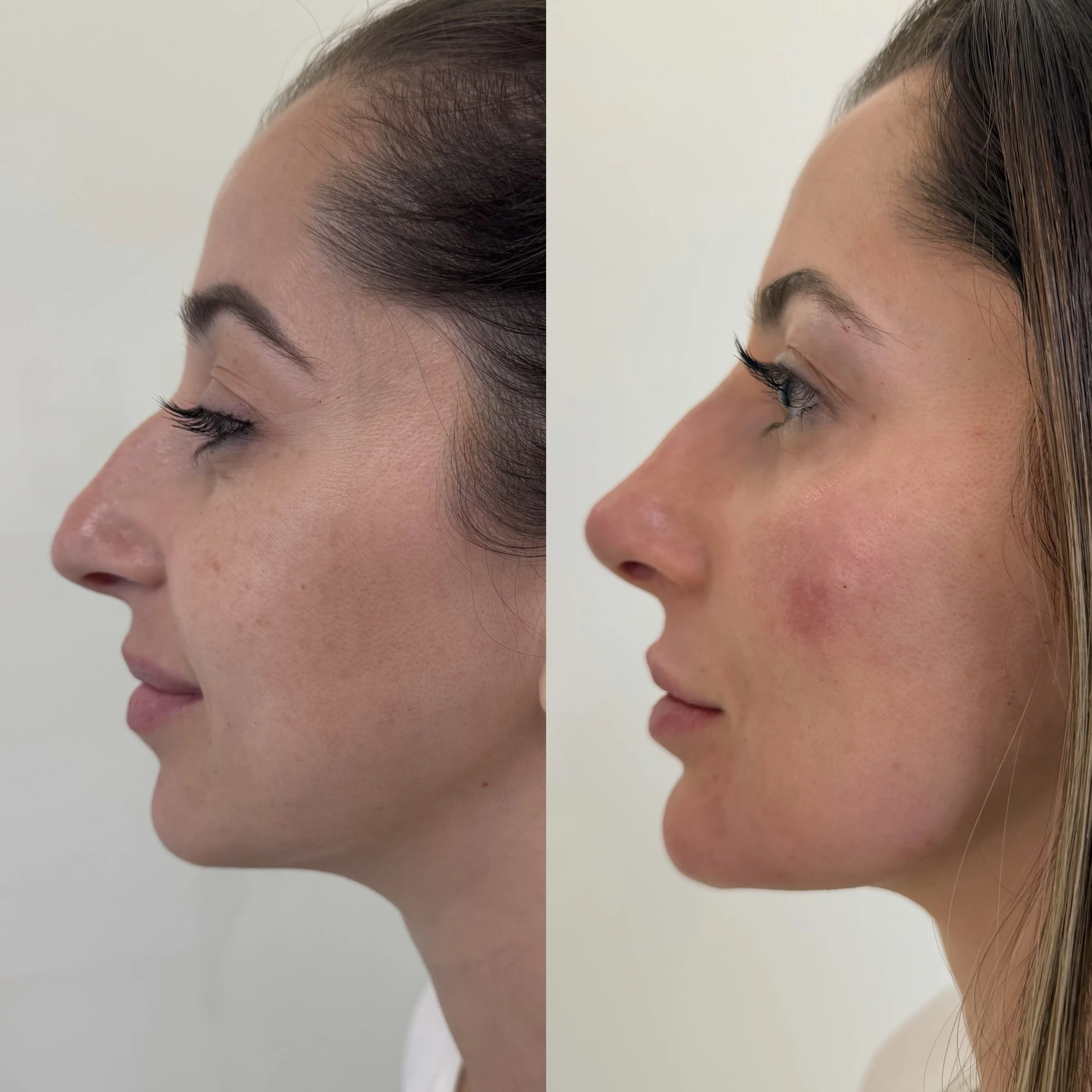 Antes e depois de paciente tratada pela Dra. Vanessa Goes — caso 6