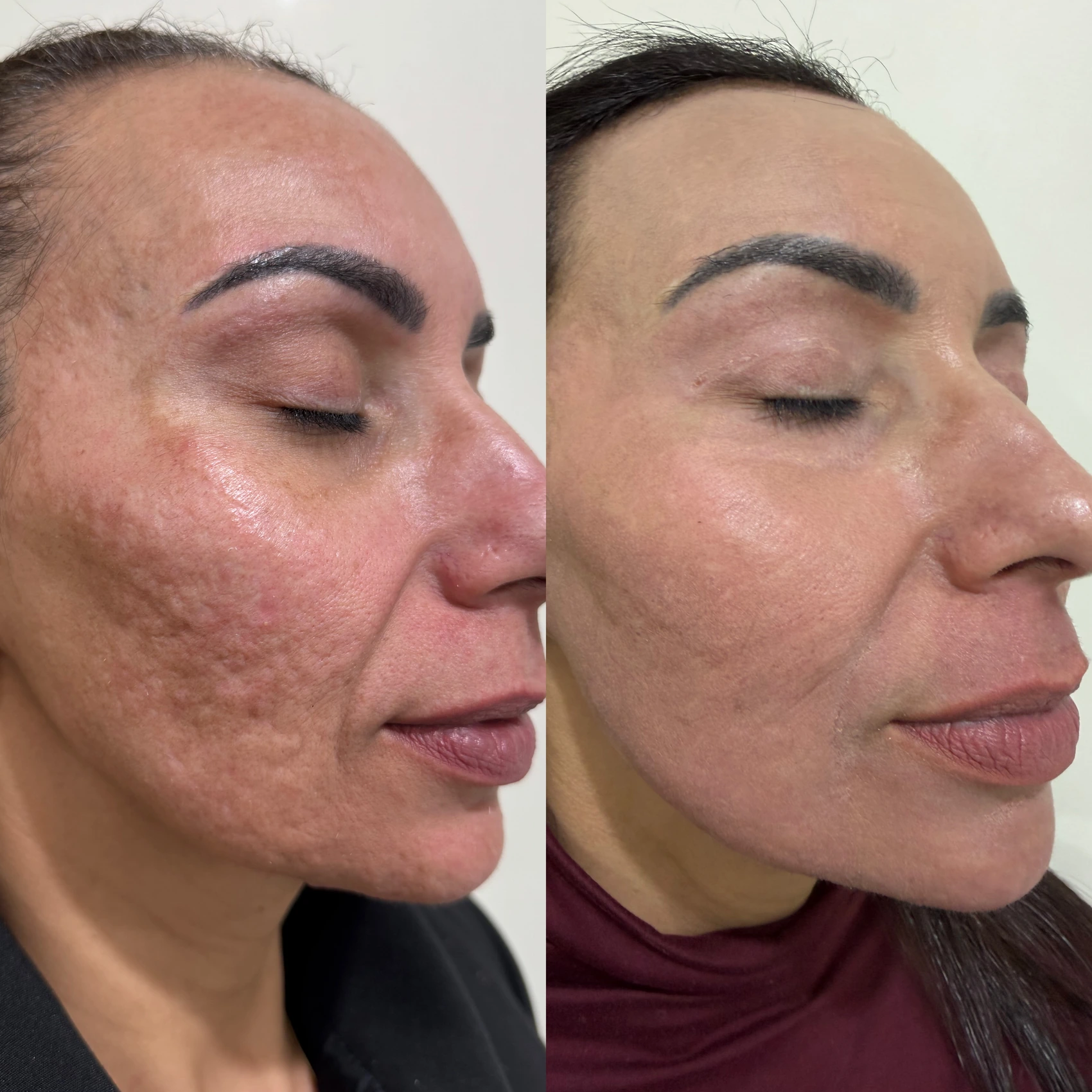 Antes e depois de paciente tratada pela Dra. Vanessa Goes — caso 7