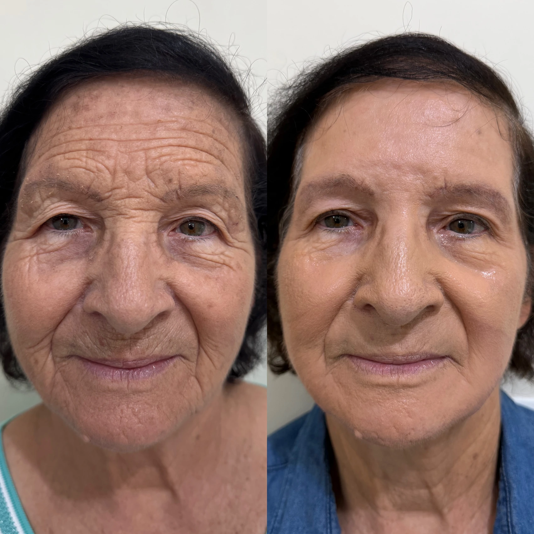 Antes e depois de paciente tratada pela Dra. Vanessa Goes — caso 8