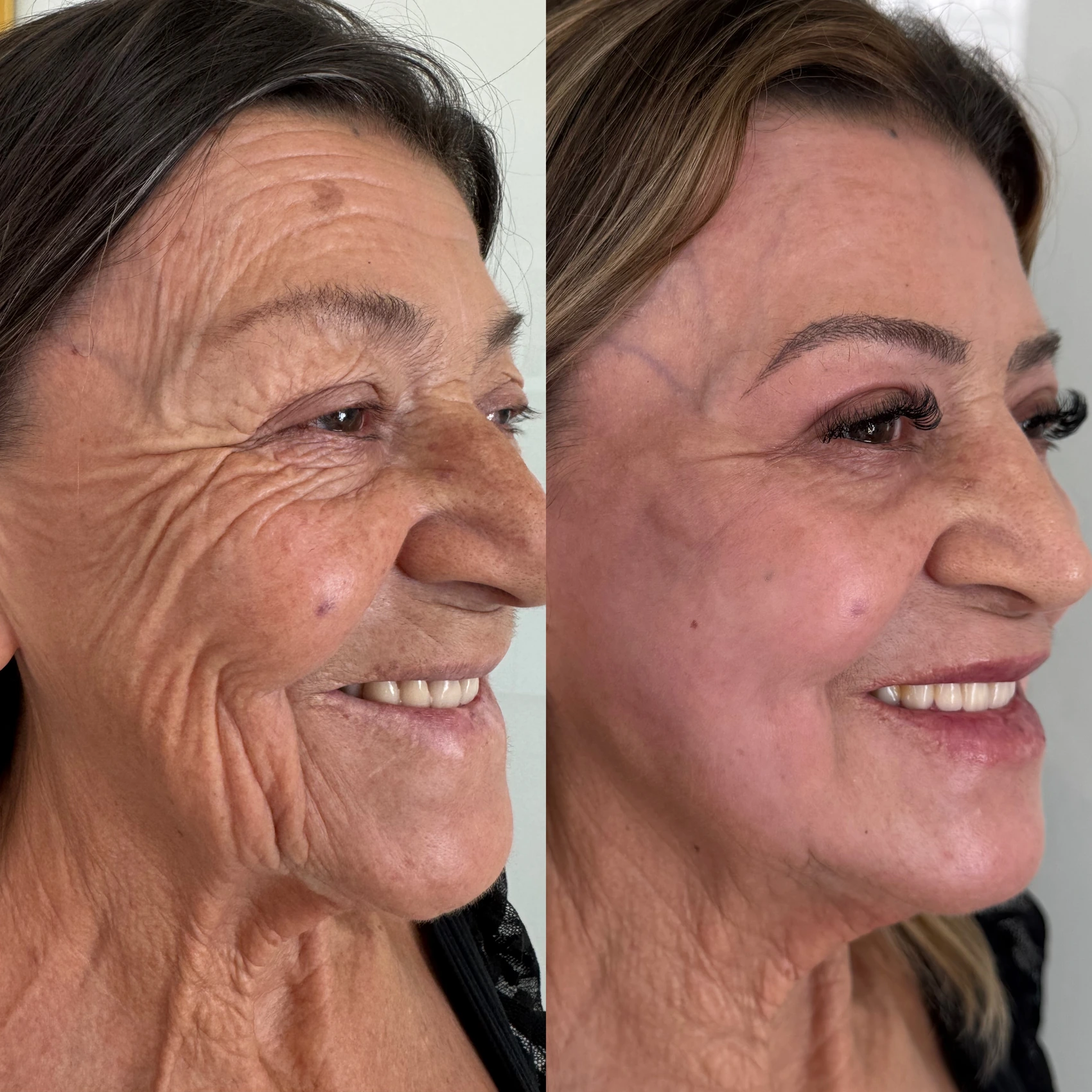 Antes e depois de paciente tratada pela Dra. Vanessa Goes — caso 9