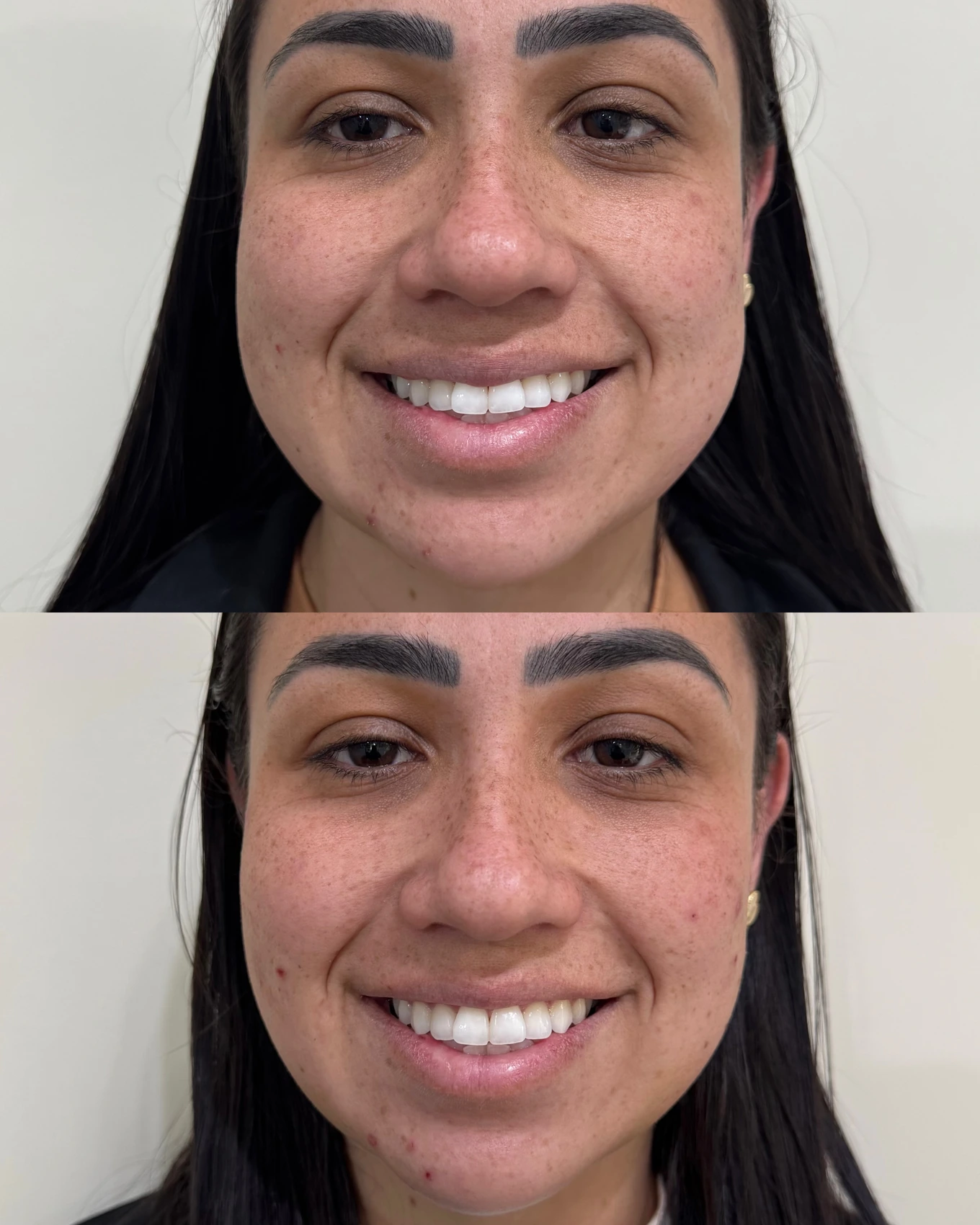 Antes e depois de paciente tratada pela Dra. Vanessa Goes — caso 10