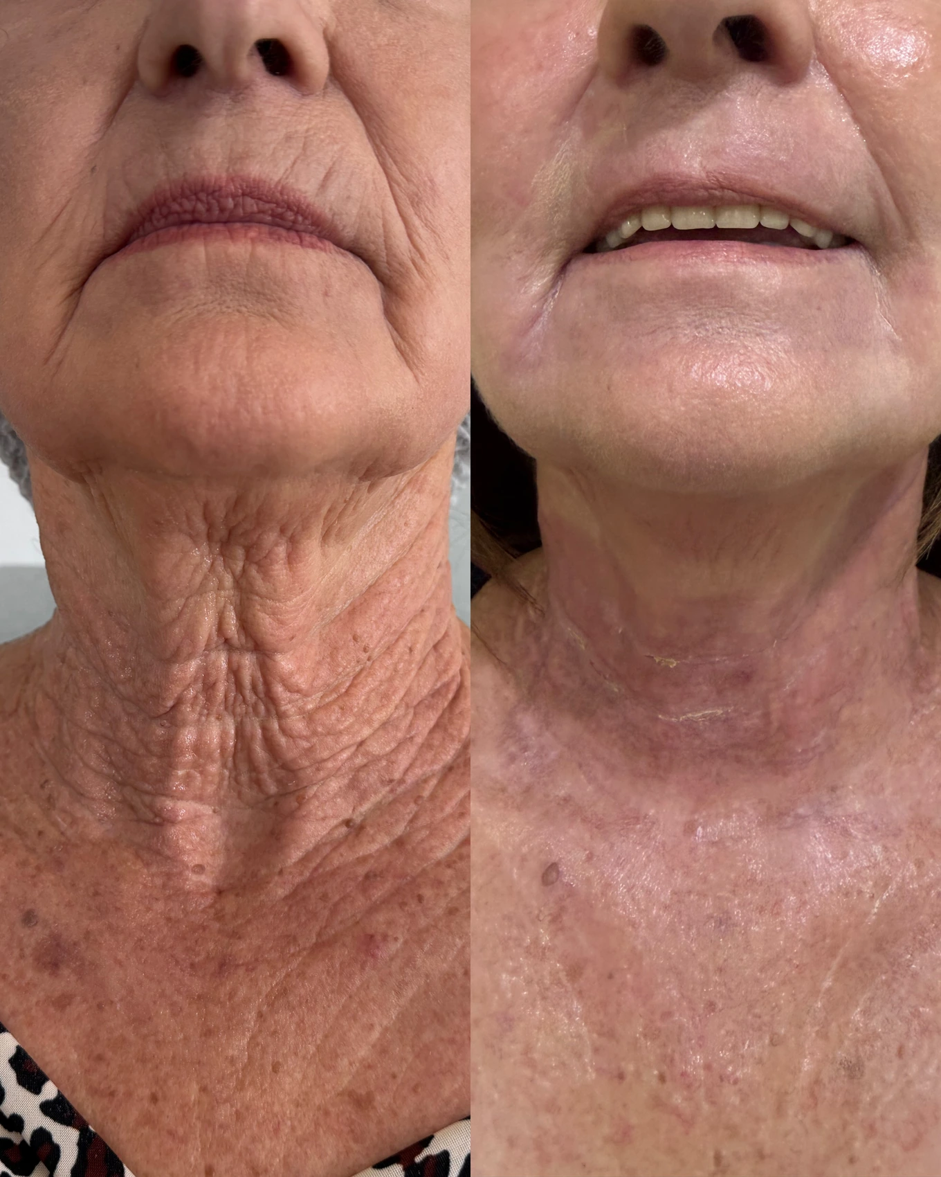 Antes e depois de paciente tratada pela Dra. Vanessa Goes — caso 11