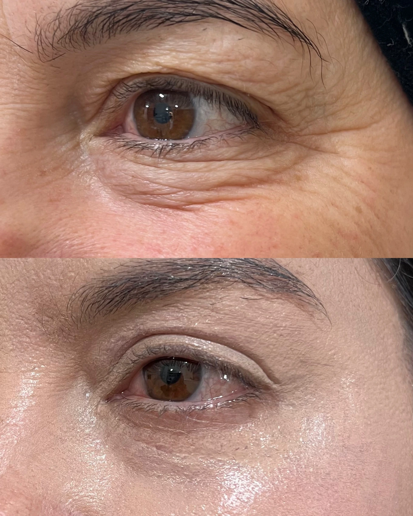 Antes e depois de paciente tratada pela Dra. Vanessa Goes — caso 12