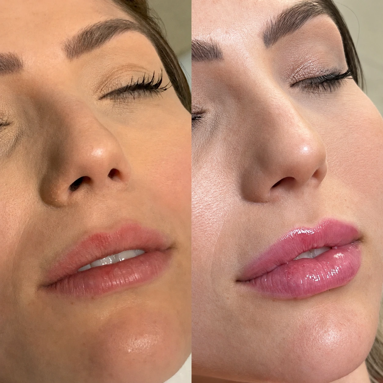 Antes e depois de paciente tratada pela Dra. Vanessa Goes — caso 13