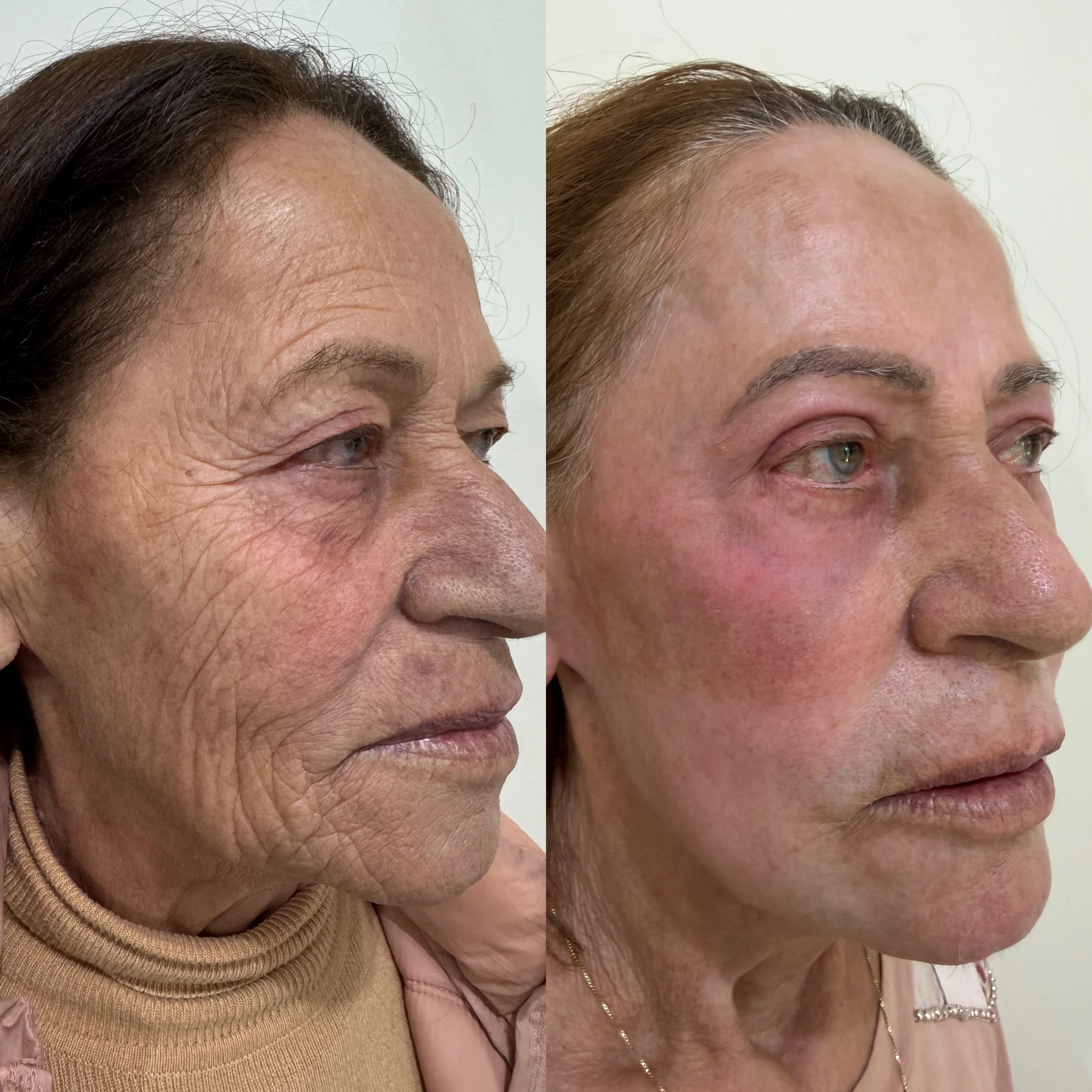 Antes e depois de paciente tratada pela Dra. Vanessa Goes — caso 14