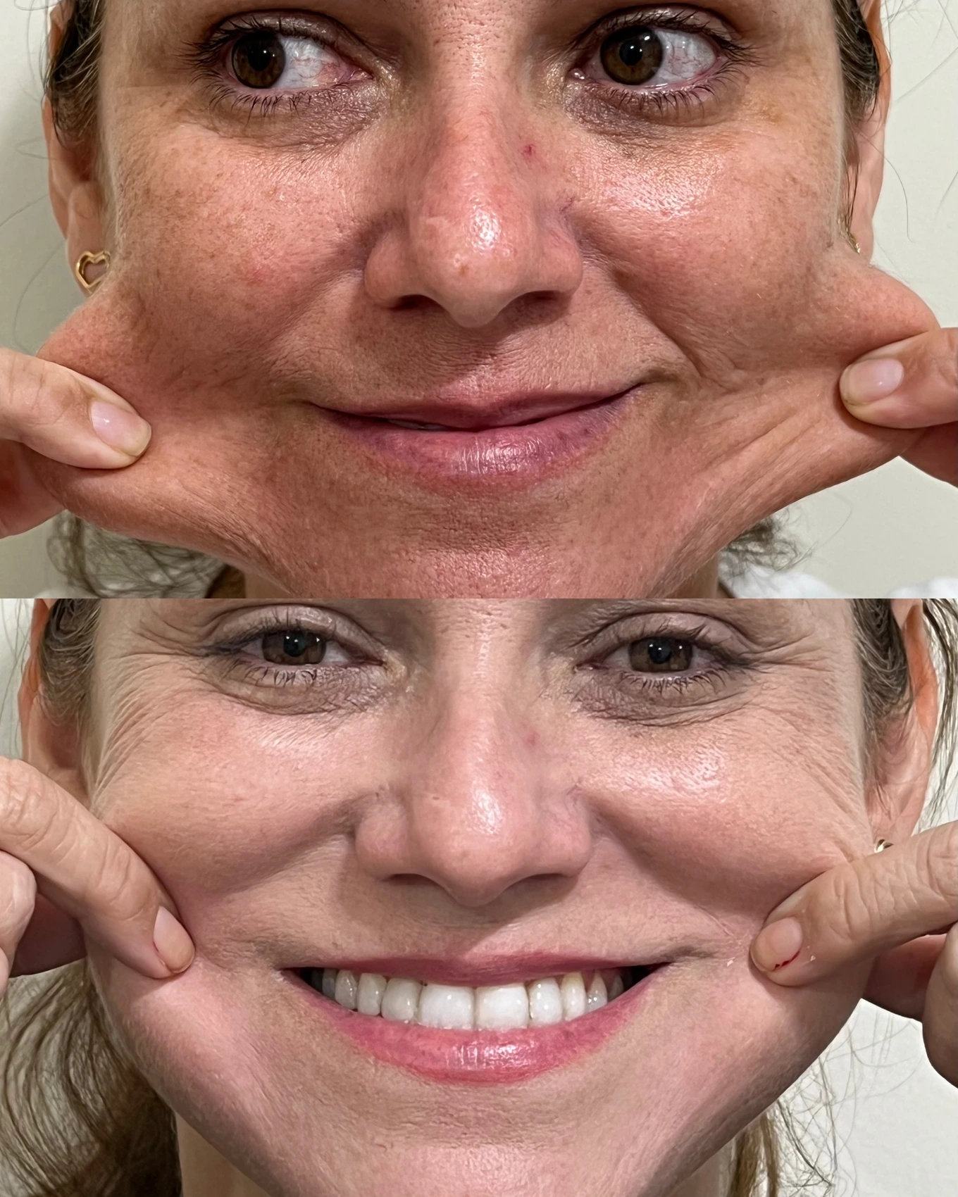 Antes e depois de paciente tratada pela Dra. Vanessa Goes — caso 15