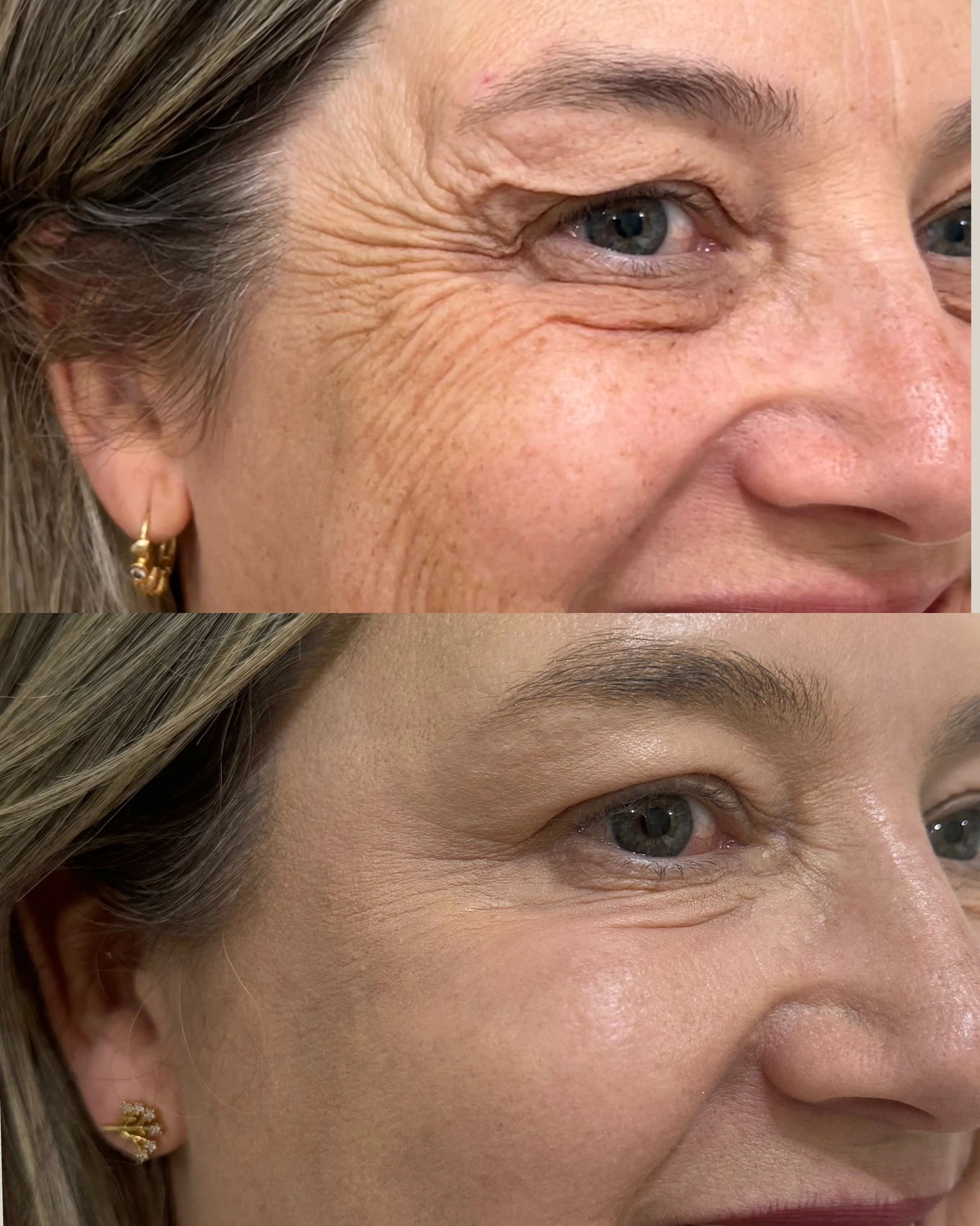 Antes e depois de paciente tratada pela Dra. Vanessa Goes — caso 16