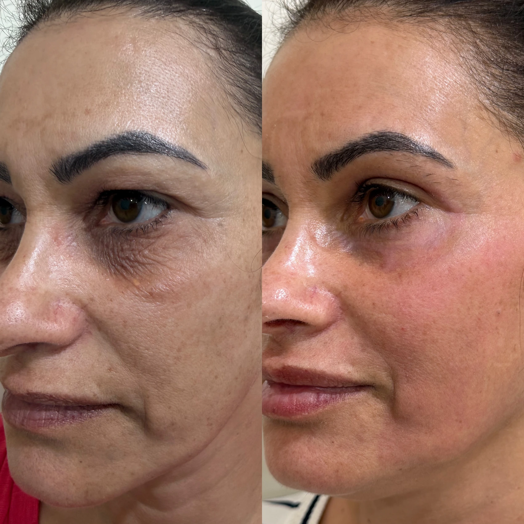 Antes e depois de paciente tratada pela Dra. Vanessa Goes — caso 17