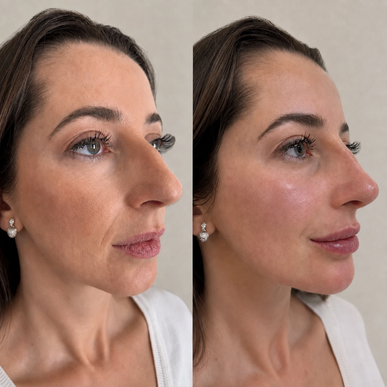 Antes e depois de paciente tratada pela Dra. Vanessa Goes — caso 18