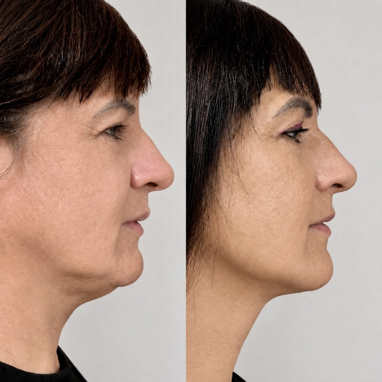 Antes e depois de paciente tratada pela Dra. Vanessa Goes — caso 19