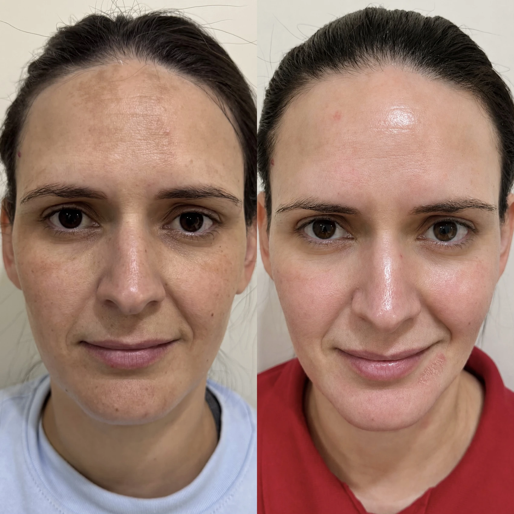 Antes e depois de paciente tratada pela Dra. Vanessa Goes — caso 20