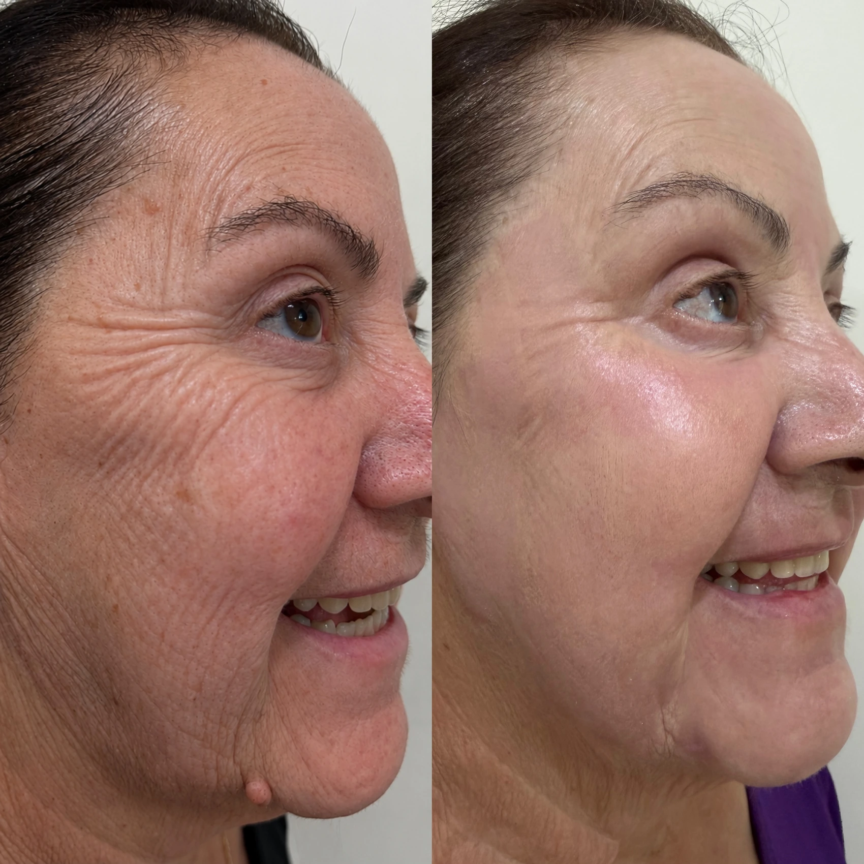 Antes e depois de paciente tratada pela Dra. Vanessa Goes — caso 21