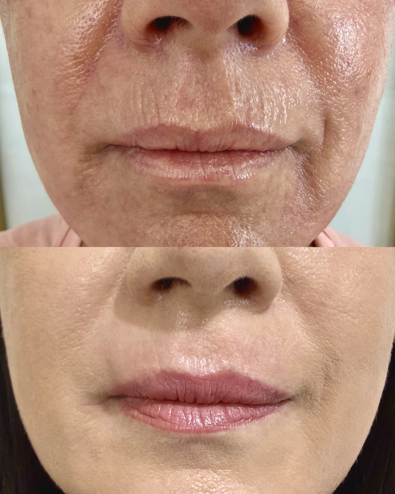 Antes e depois de paciente tratada pela Dra. Vanessa Goes — caso 22