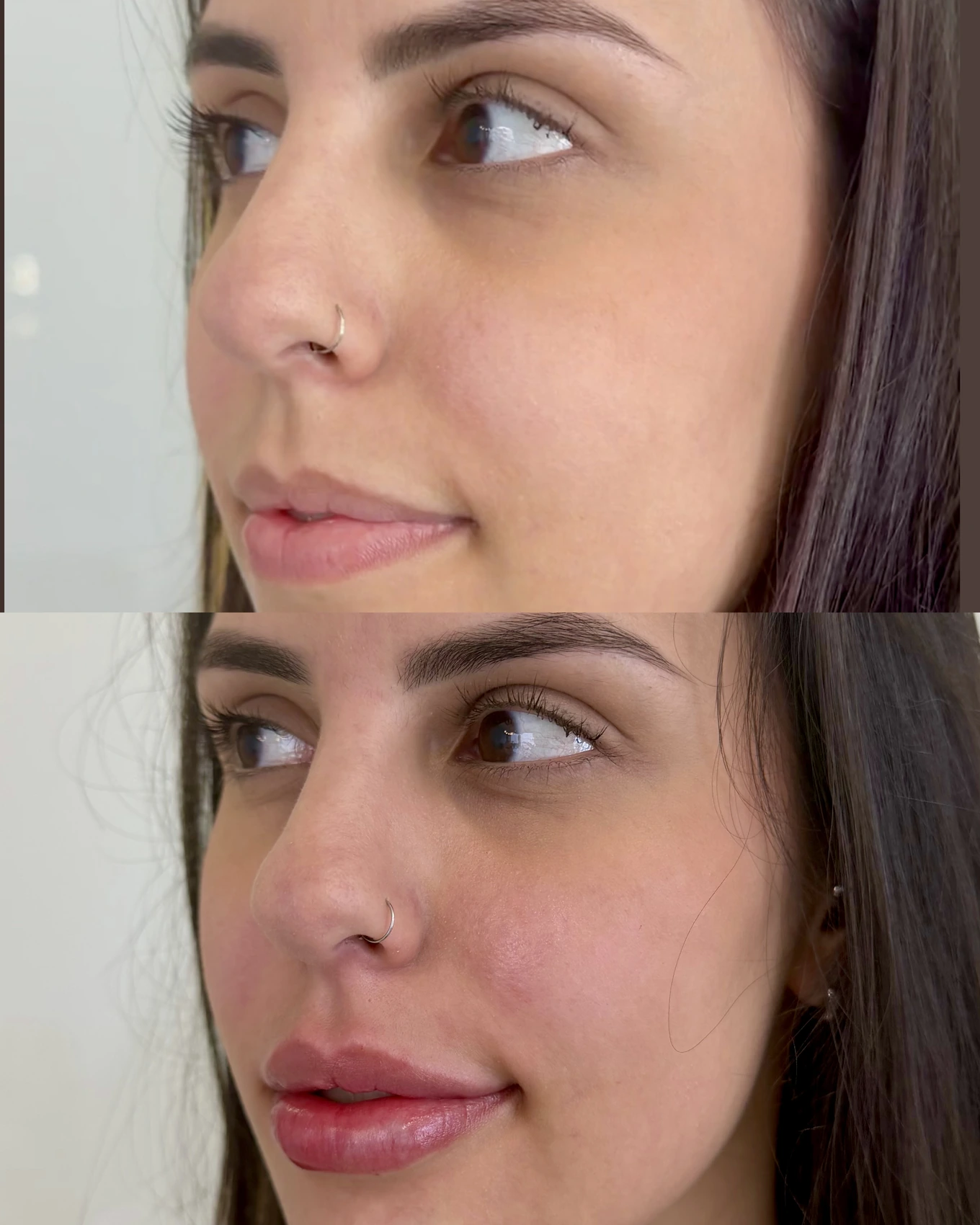 Antes e depois de paciente tratada pela Dra. Vanessa Goes — caso 23