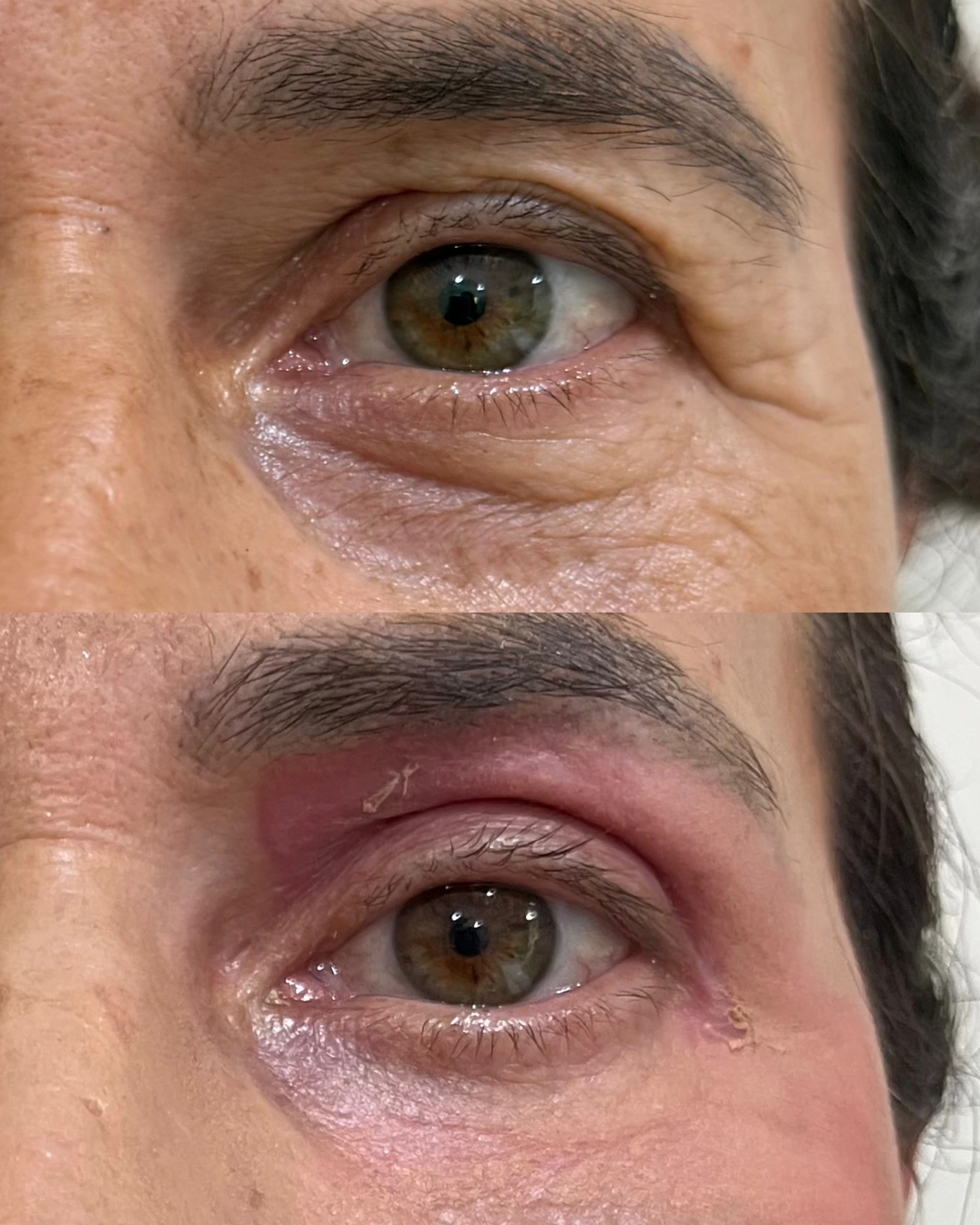 Antes e depois de paciente tratada pela Dra. Vanessa Goes — caso 24