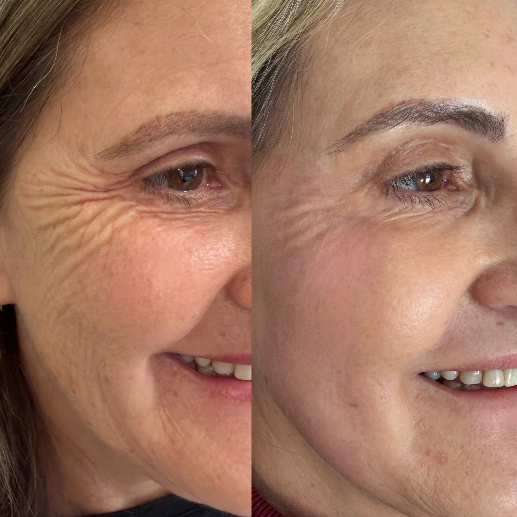 Antes e depois de paciente tratada pela Dra. Vanessa Goes — caso 26