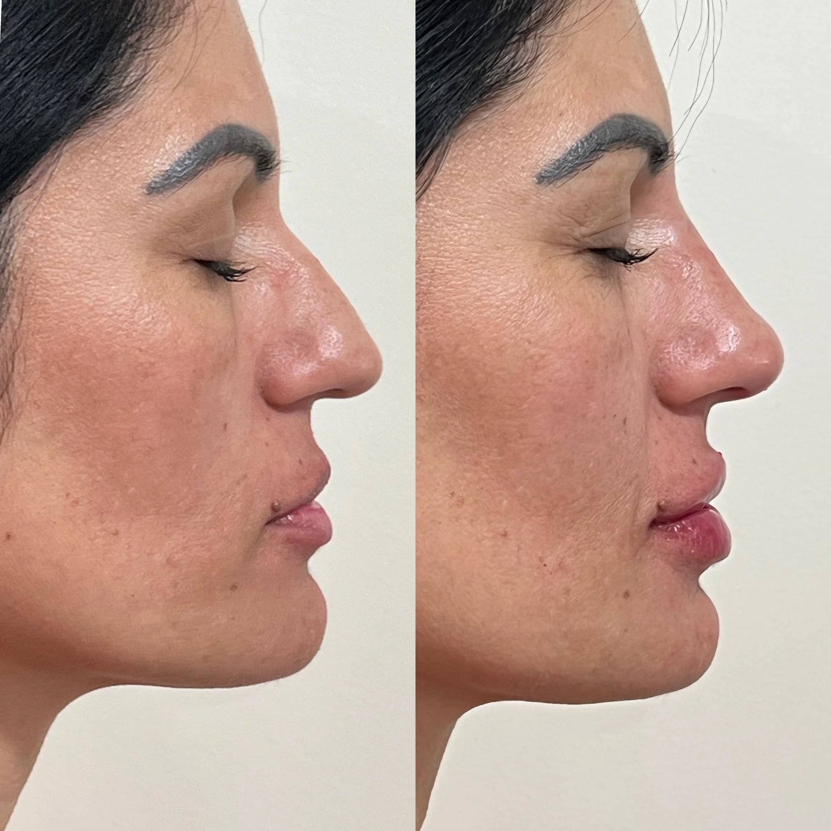 Antes e depois de paciente tratada pela Dra. Vanessa Goes — caso 27