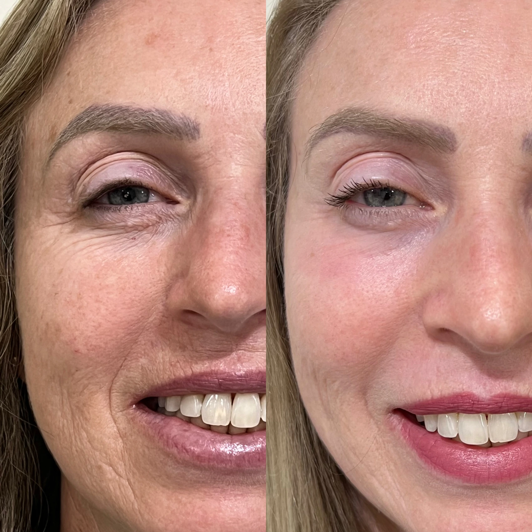 Antes e depois de paciente tratada pela Dra. Vanessa Goes — caso 28
