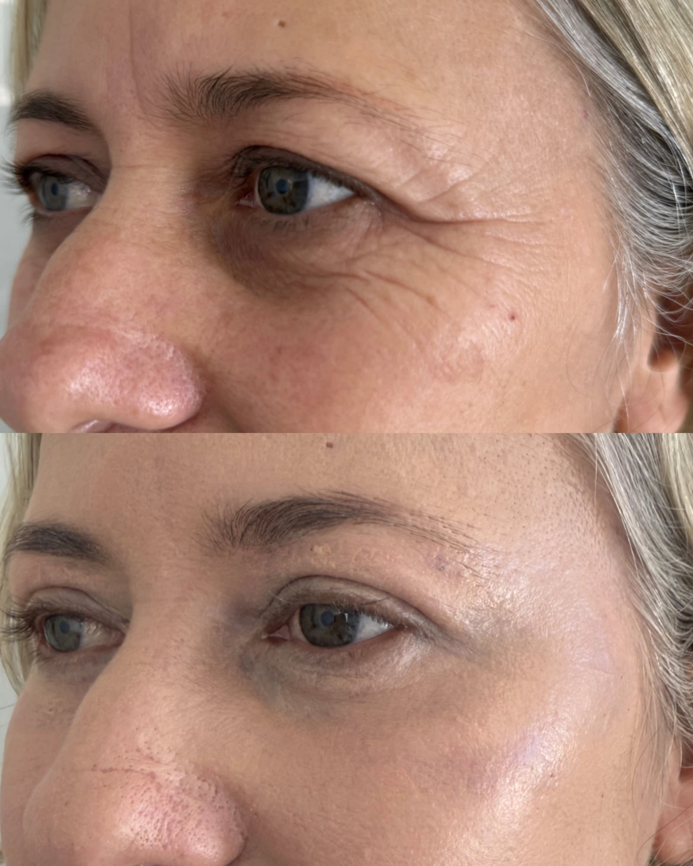 Antes e depois de paciente tratada pela Dra. Vanessa Goes — caso 29