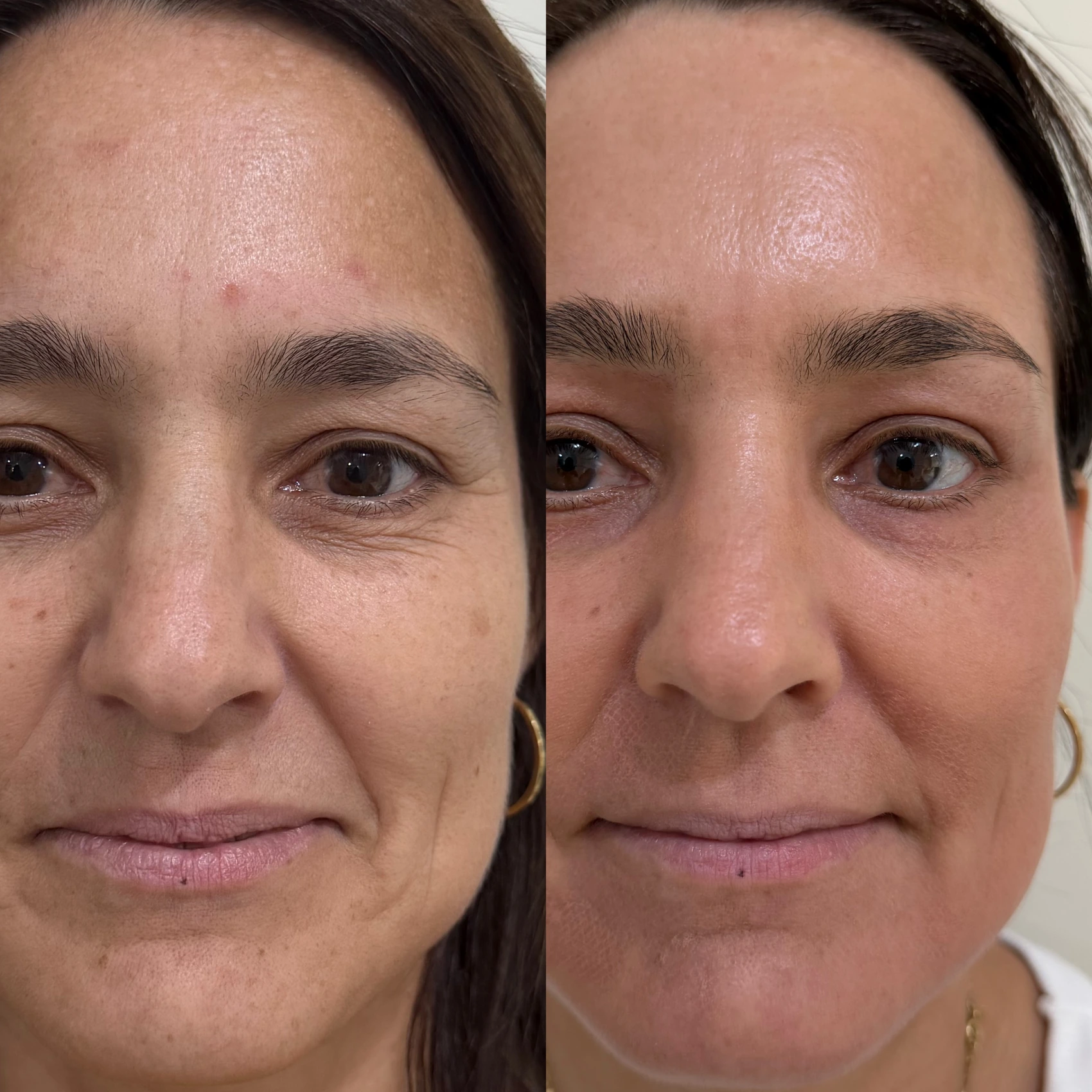 Antes e depois de paciente tratada pela Dra. Vanessa Goes — caso 30
